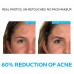 La Roche-Posay Effaclar Dermatological 3 Step Acne Treatment System